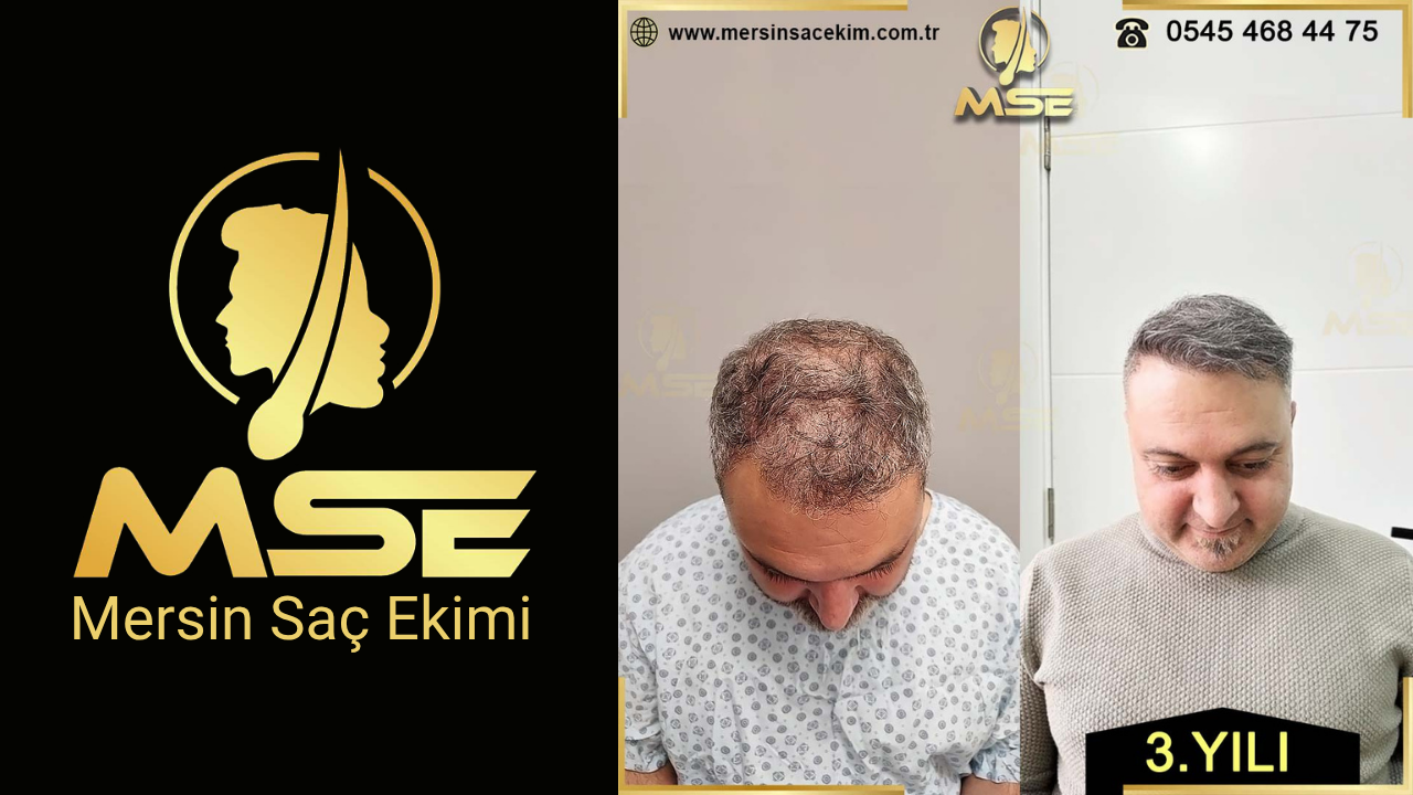 MERSİN SAÇ EKİMİ